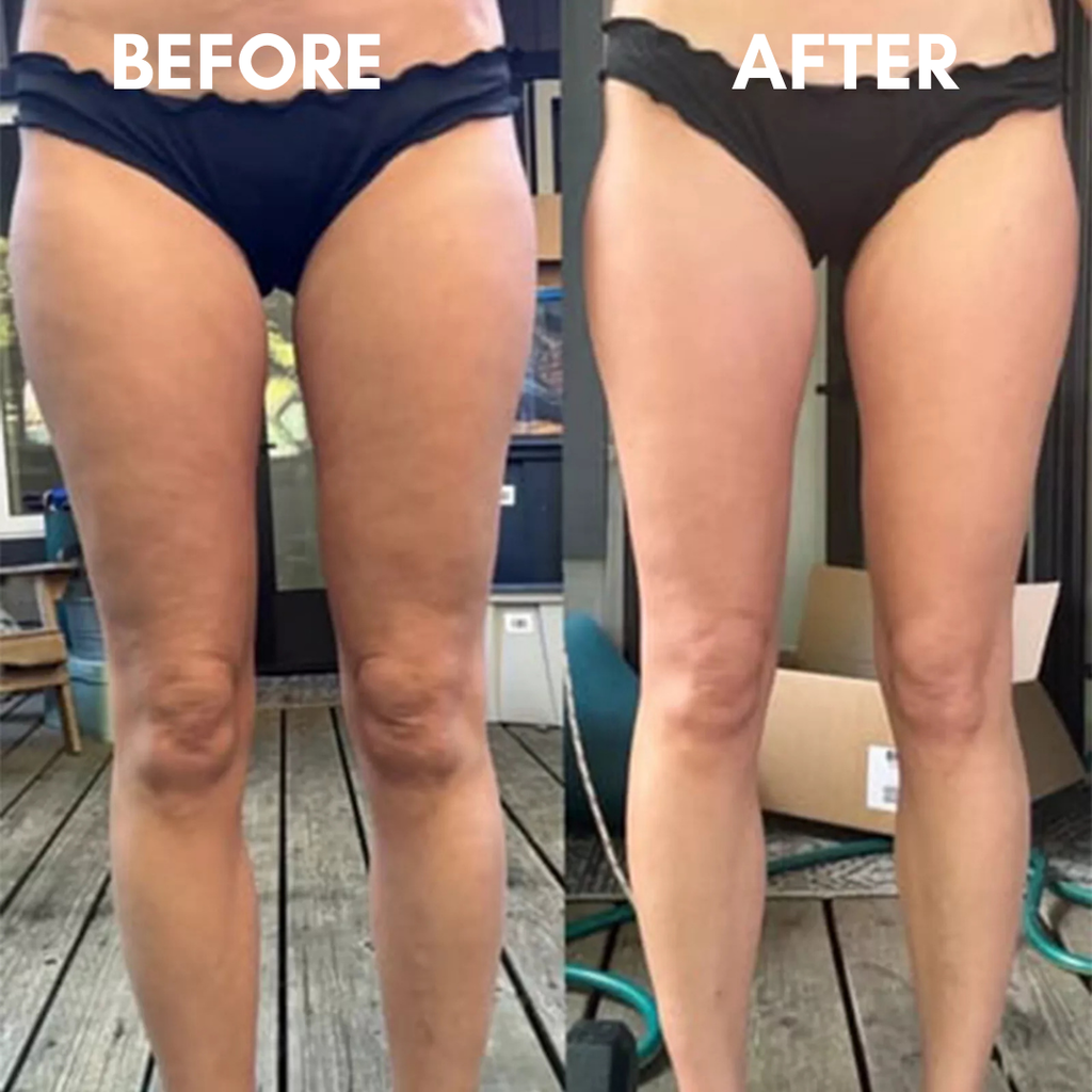 SlimSculpt Anti-Cellulite Massager