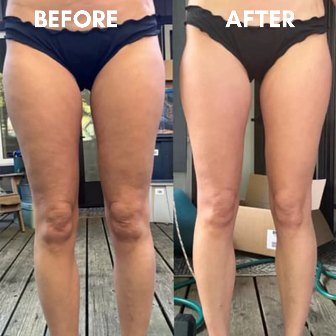 SlimSculpt Anti-Cellulite Massager