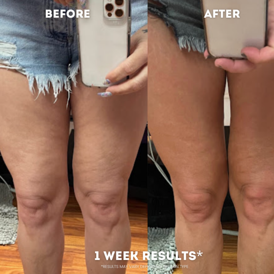 SlimSculpt Anti-Cellulite Massager