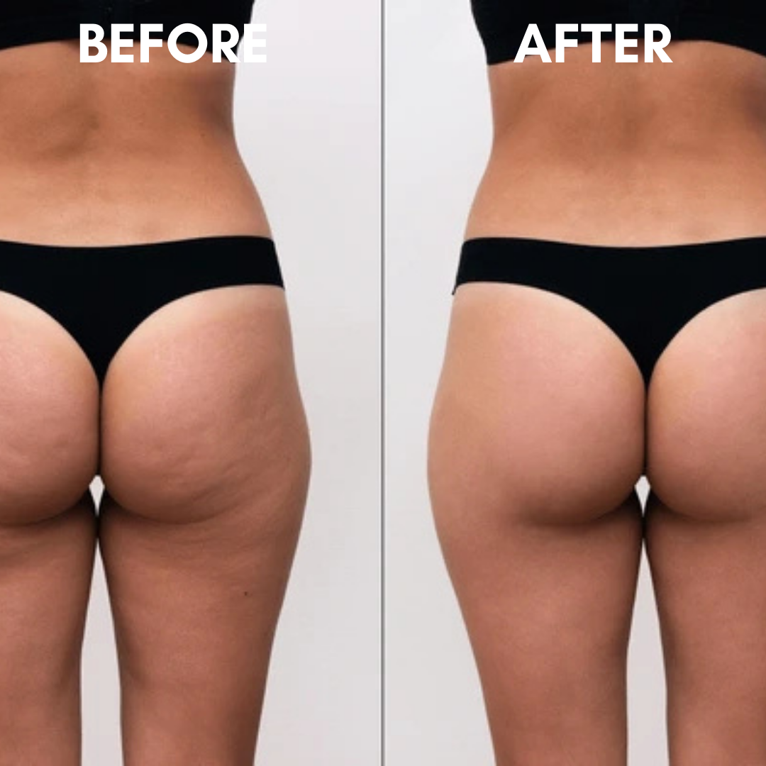 SlimSculpt Anti-Cellulite Massager